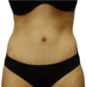 After Image: Tummy Tuck