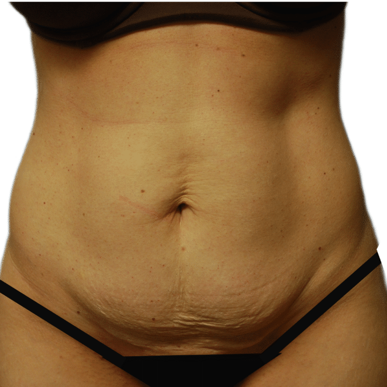 Before Image: Tummy Tuck - front