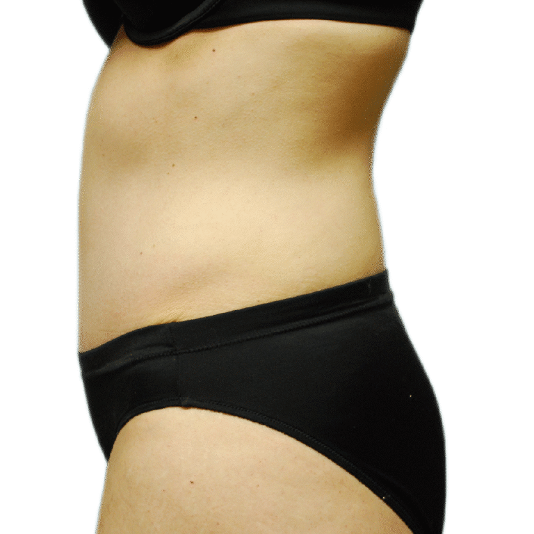 After Image: Tummy Tuck - left-side