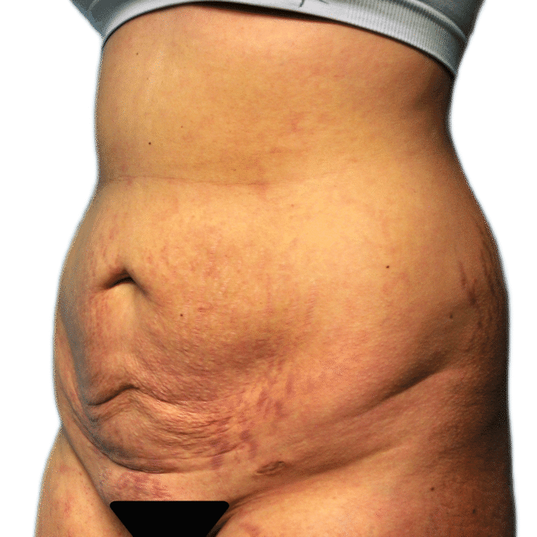 Before Image: Tummy Tuck -