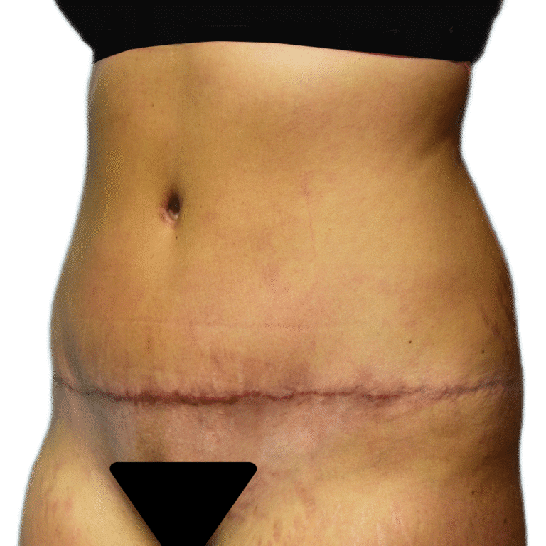 After Image: Tummy Tuck -