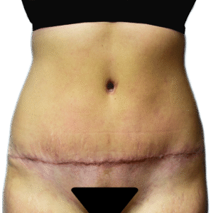 After Image: Tummy Tuck