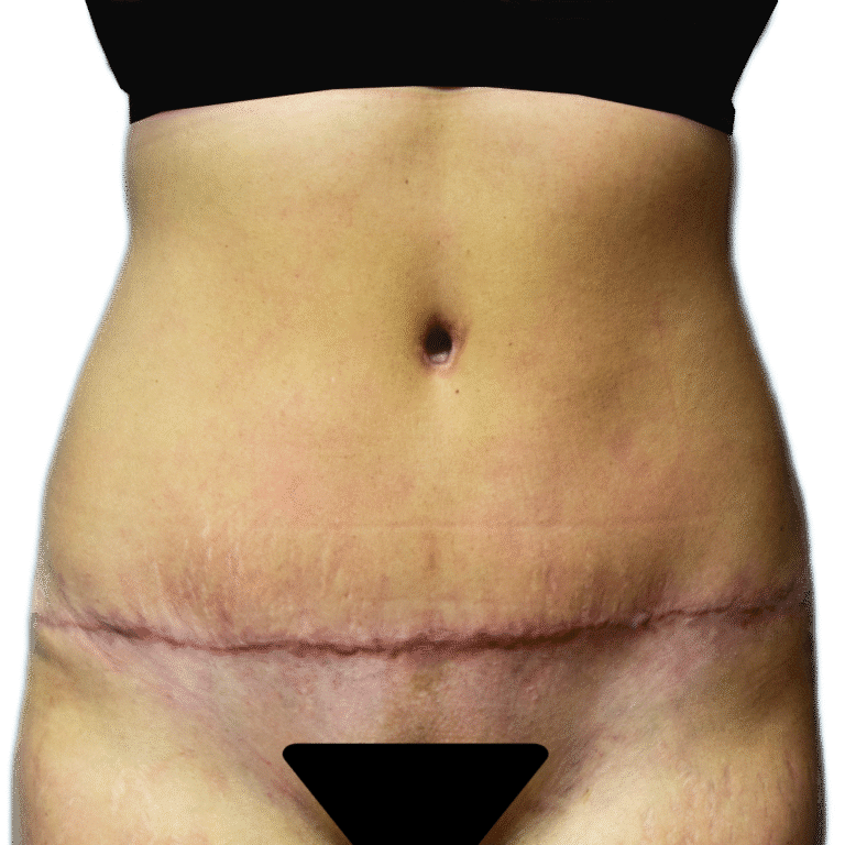 After Image: Tummy Tuck - front