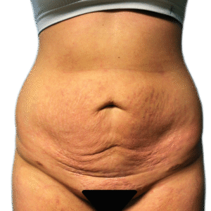 Before Image: Tummy Tuck