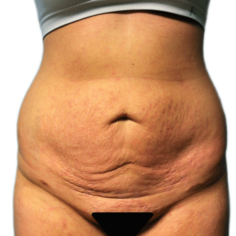 Before Image: Tummy Tuck - front