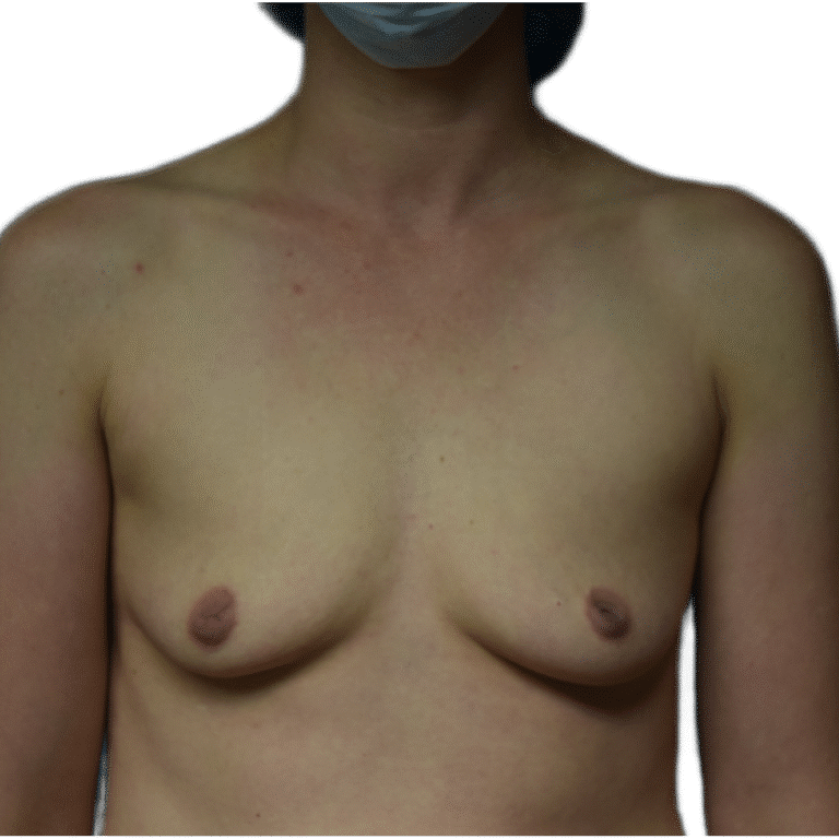Before Image: Breast Augmentation - front