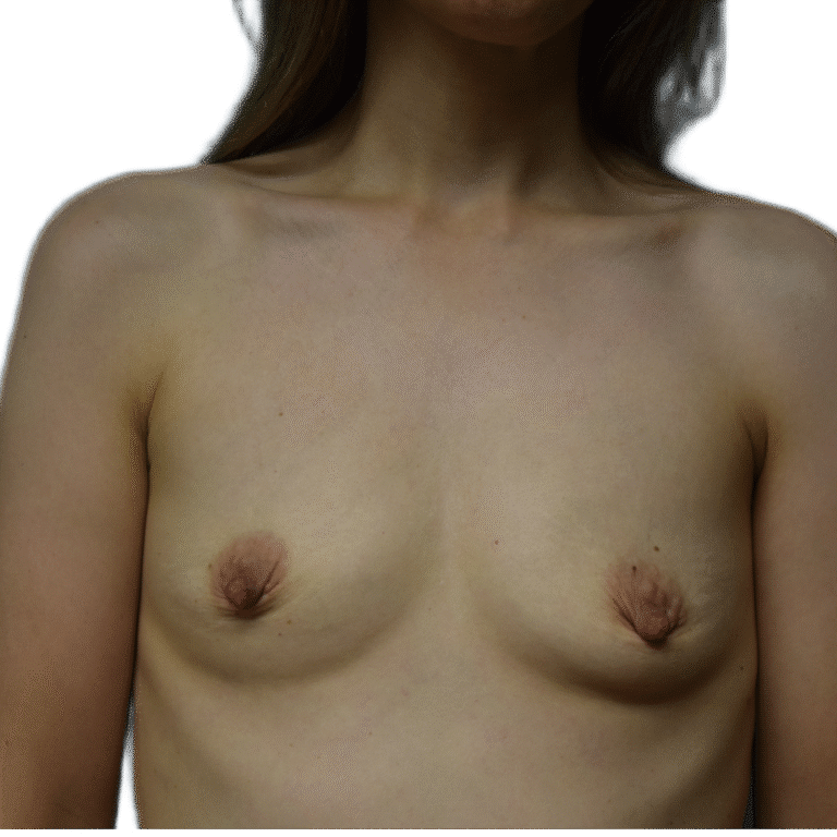 Before Image: Fat Grafting to Breast with Liposuction - front