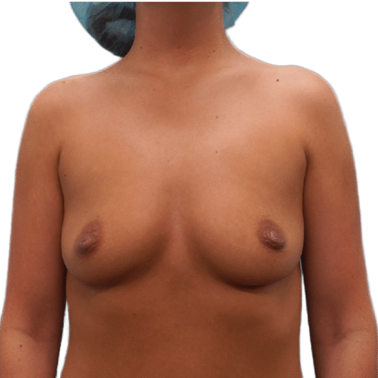 Before Image: Breast Augmentation - front
