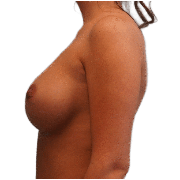 After Image: Breast Augmentation - left-side