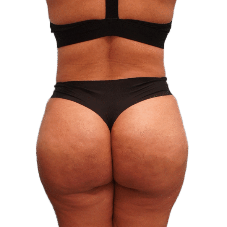 After Image: BBL - back