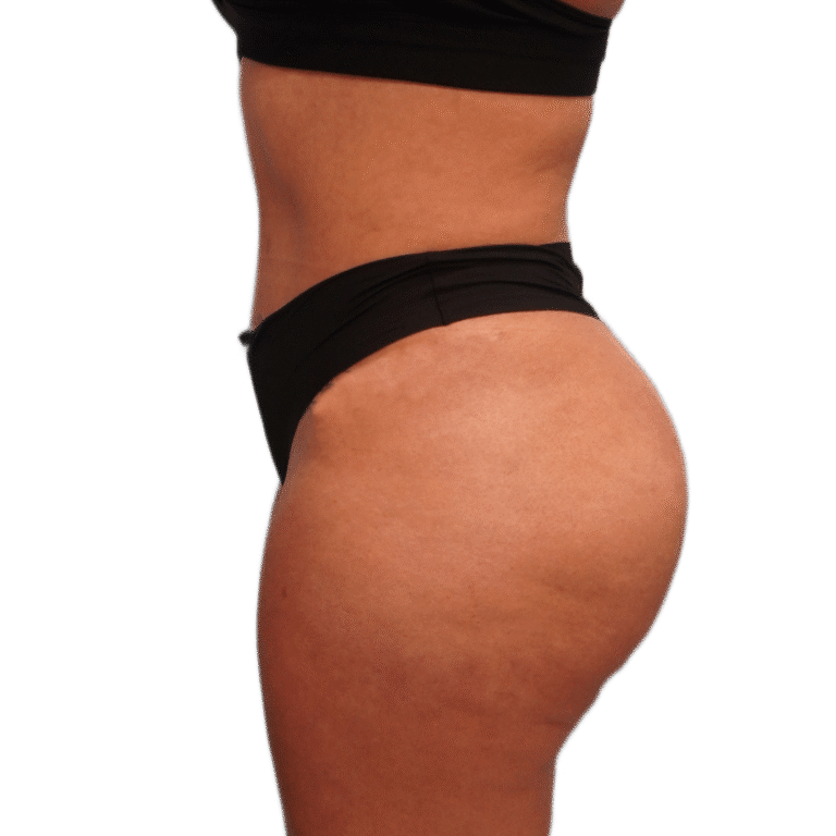 After Image: BBL - left-side