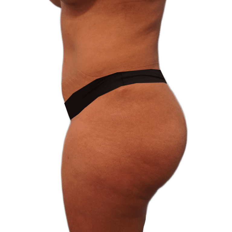 Before Image: BBL - left-side