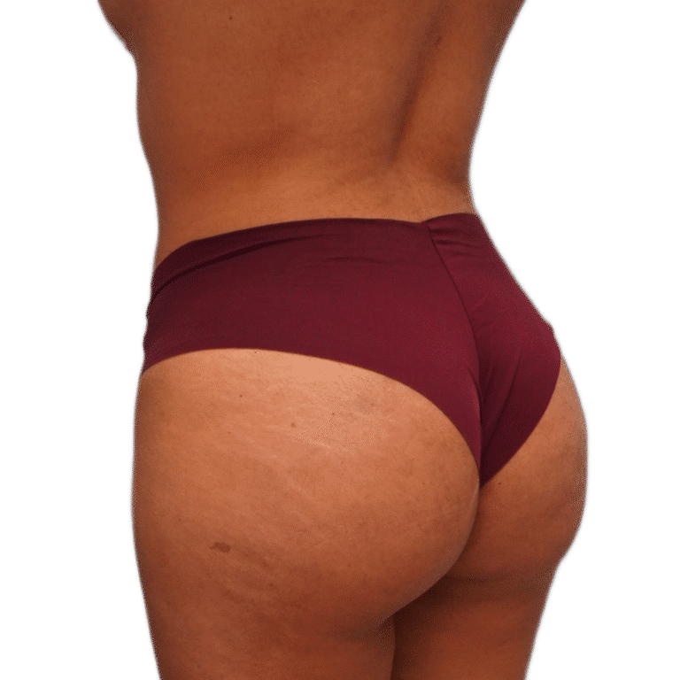 After Image: BBL - left-back-oblique