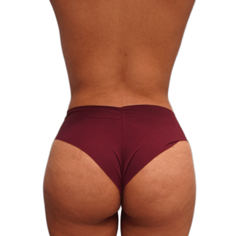 After Image: BBL - back