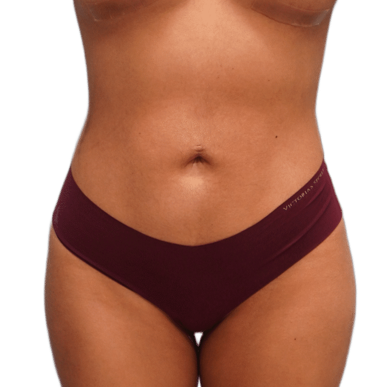 After Image: BBL - front