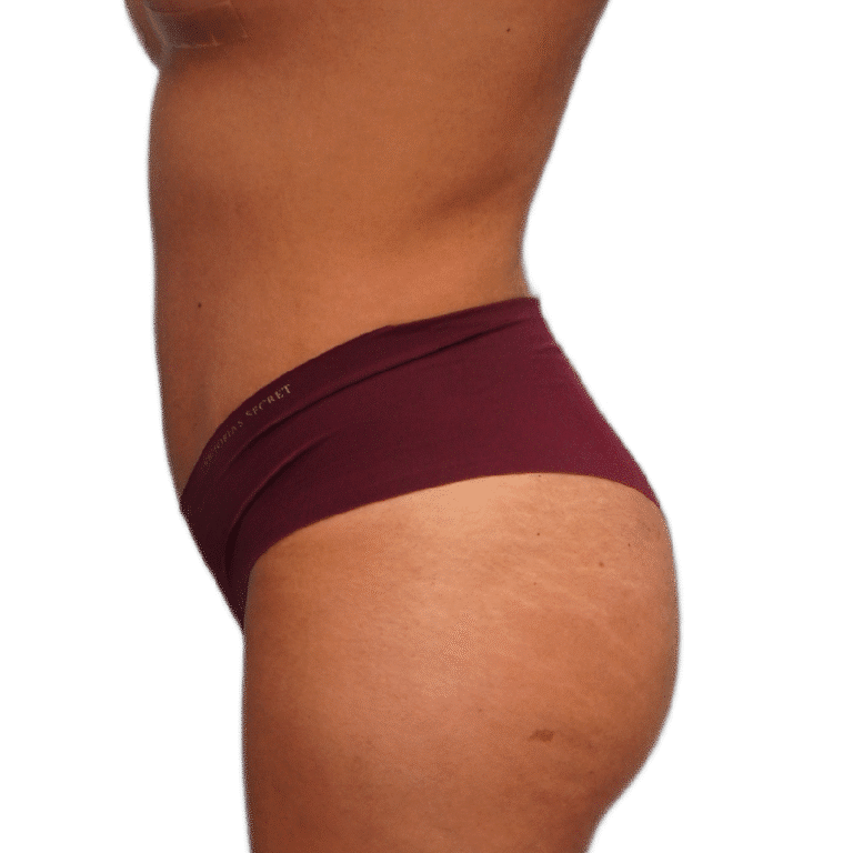 After Image: BBL - left-side