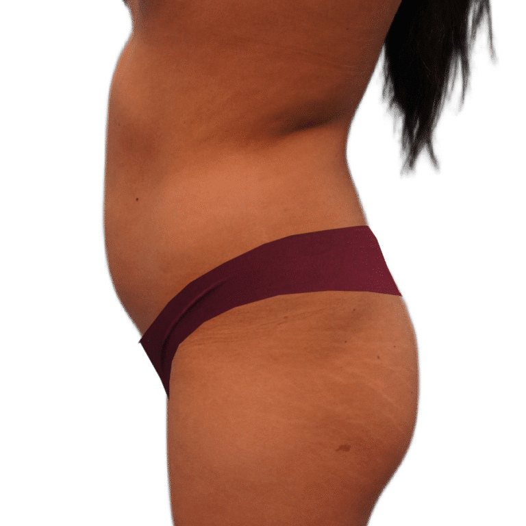 Before Image: BBL - left-side