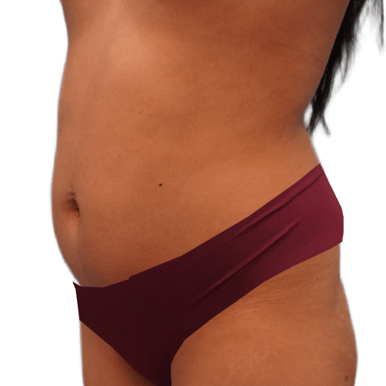 Before Image: BBL - left-front-oblique