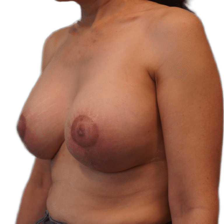 After Image: Breast Augmentation w/Lift - left-front-oblique