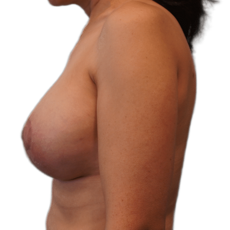 After Image: Breast Augmentation w/Lift - left-side