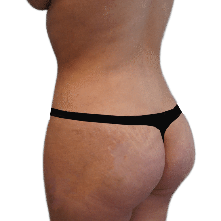 After Image: Liposuction 360 - left-back-oblique