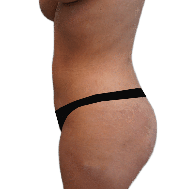 After Image: Liposuction 360 - left-side