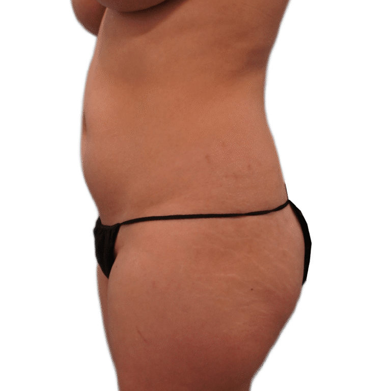 Before Image: Liposuction 360 - left-side
