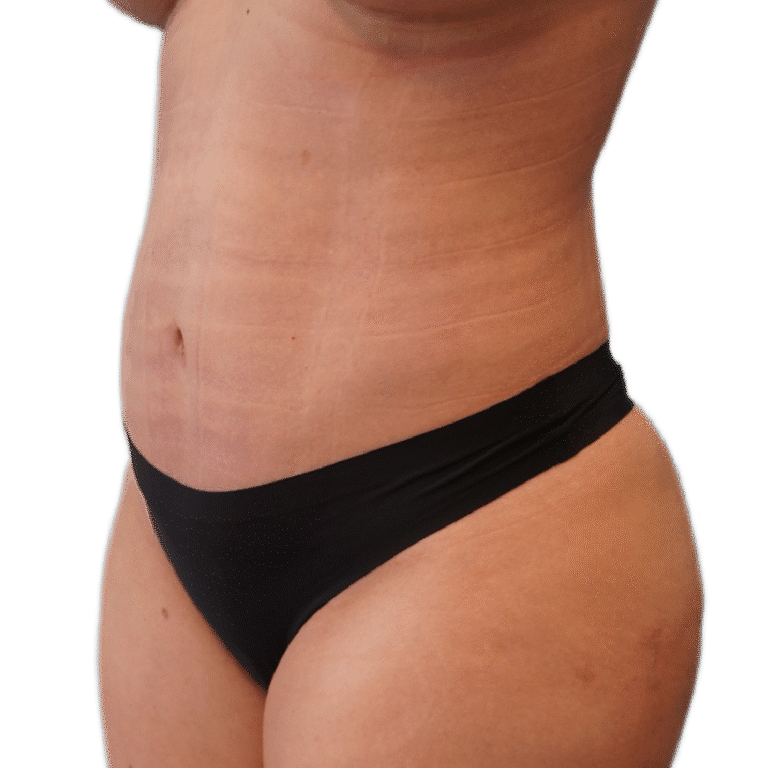 After Image: Liposuction 360 - left-front-oblique