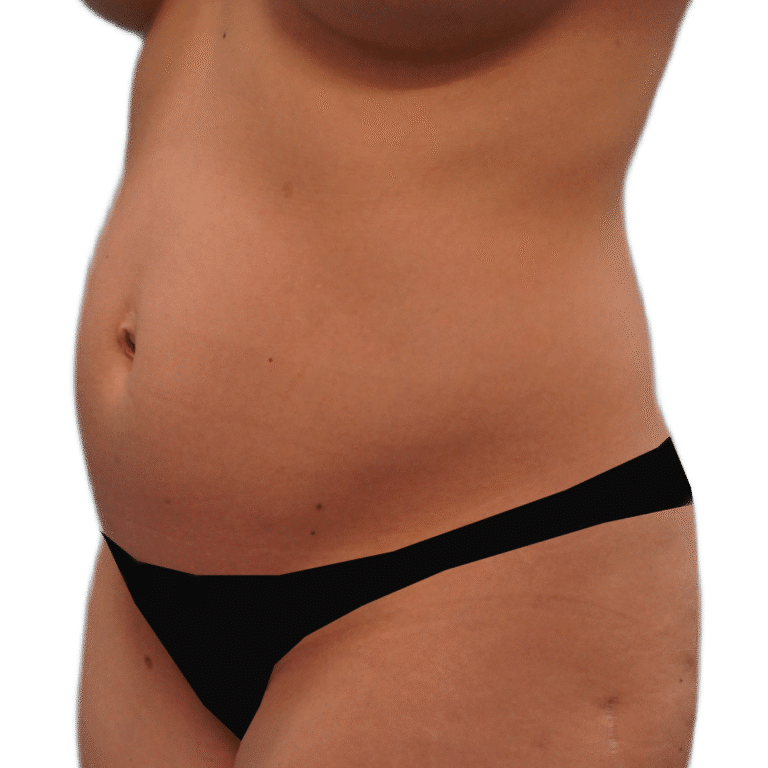 Before Image: Liposuction 360 - left-front-oblique