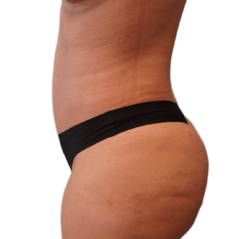 After Image: Liposuction 360 - left-side