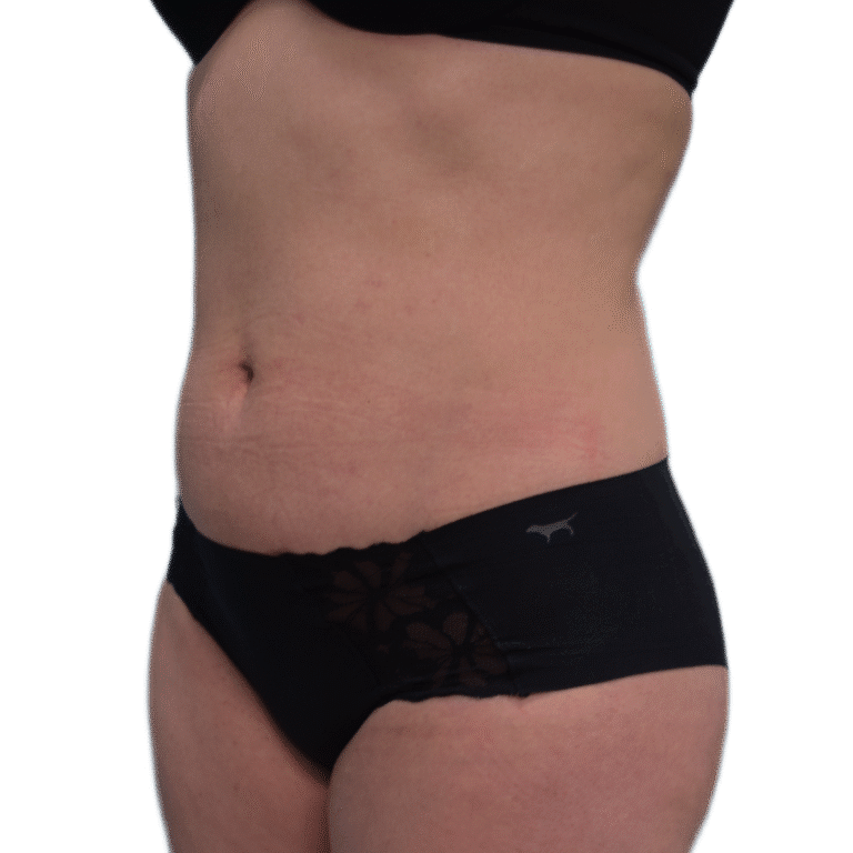 After Image: Liposuction - left-front-oblique