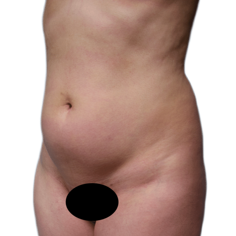 Before Image: Liposuction - left-front-oblique