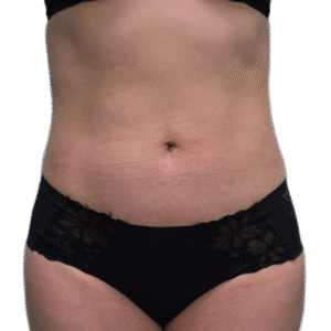 After Image: Liposuction