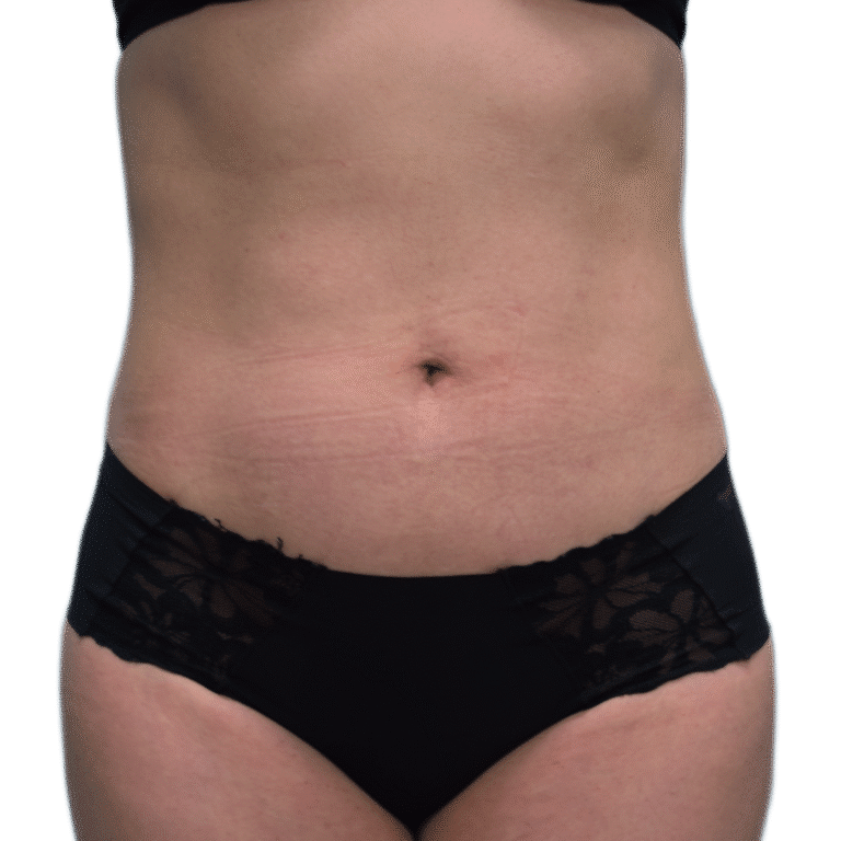 After Image: Liposuction - front