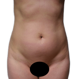 Before Image: Liposuction
