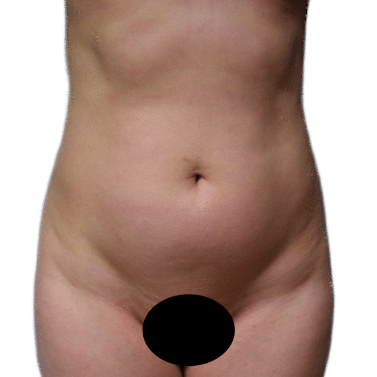 Before Image: Liposuction - front