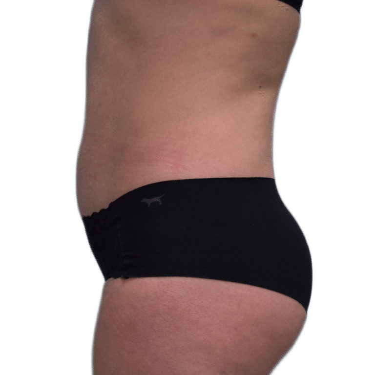 After Image: Liposuction - left-side