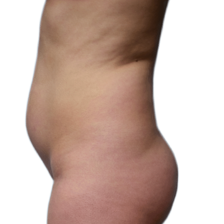 Before Image: Liposuction - left-side