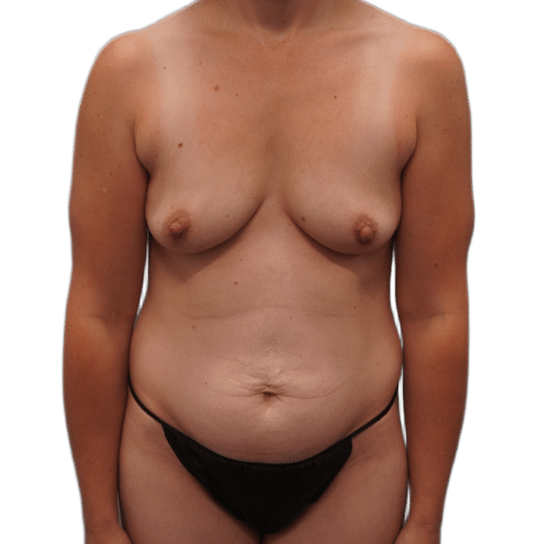 Before Image: Mommy Makeover (Tummy Tuck and Breast Augmentation) - front
