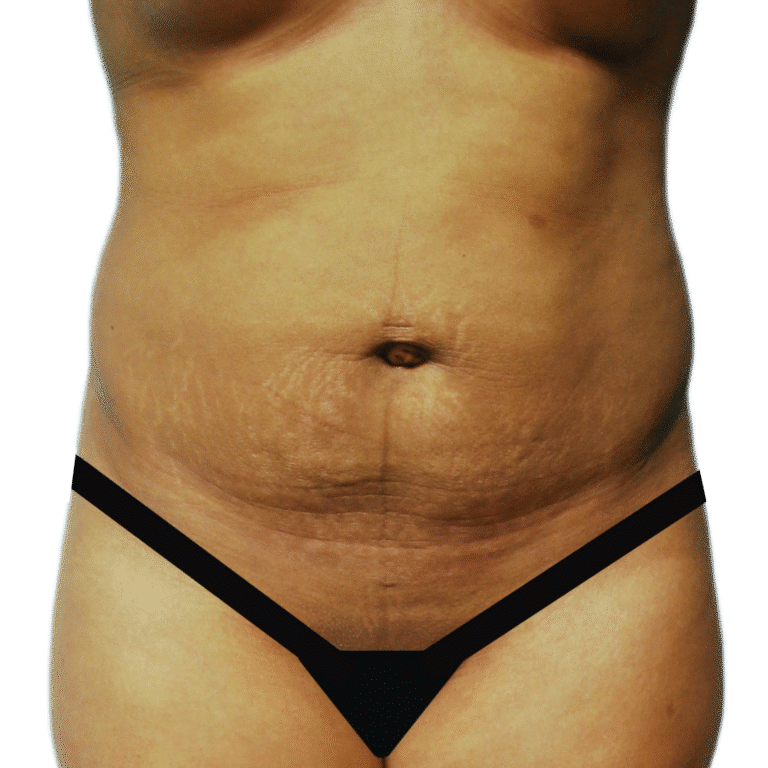 Before Image: Tummy Tuck w/ BBL - front