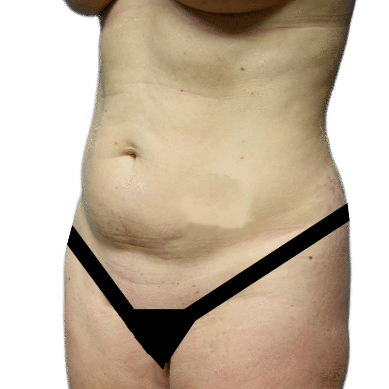 Before Image: Tummy Tuck - left-front-oblique