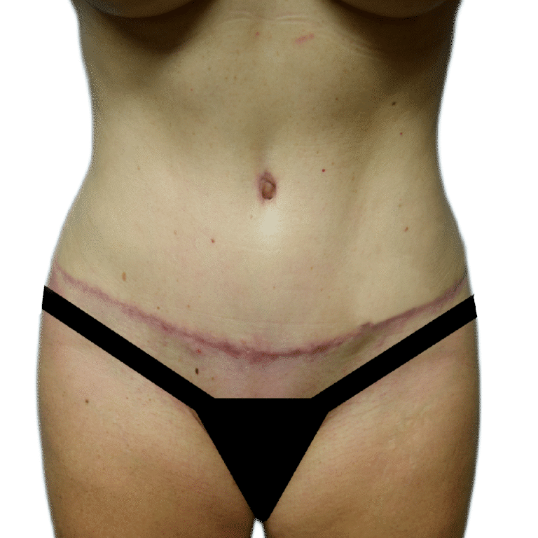 After Image: Tummy Tuck - front