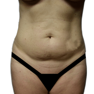 Before Image: Tummy Tuck