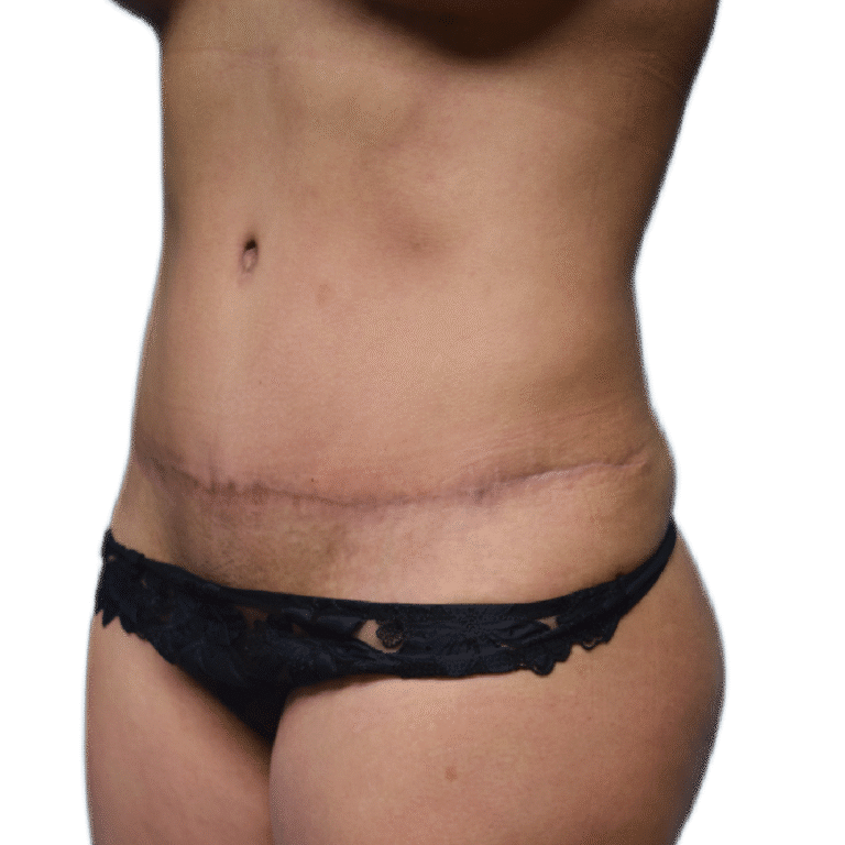 After Image: Tummy Tuck w/ BBL - left-front-oblique