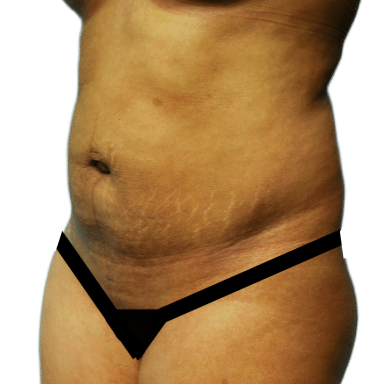 Before Image: Tummy Tuck w/ BBL - left-front-oblique