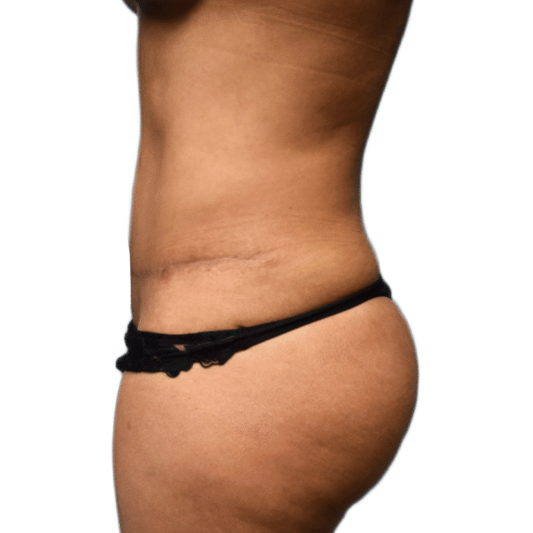 After Image: Tummy Tuck w/ BBL - front