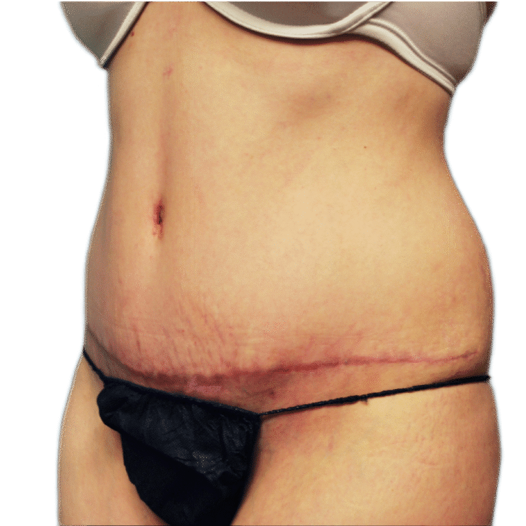 After Image: Tummy Tuck - left-front-oblique