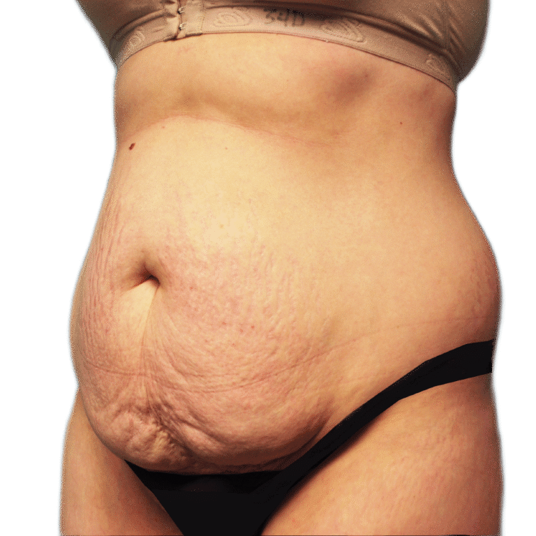 Before Image: Tummy Tuck - left-front-oblique