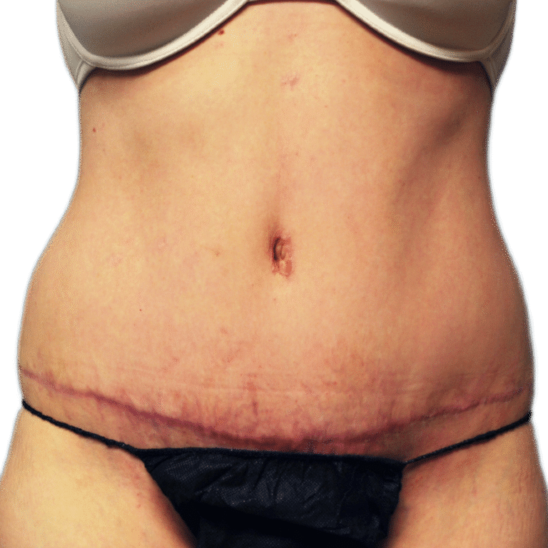 After Image: Tummy Tuck - front