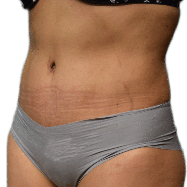 After Image: Tummy Tuck - left-front-oblique